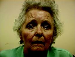 Liệt trên nhân tiến triển - Hình ảnh minh họa